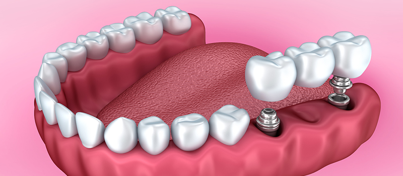 Comment faire attention à sa prothèse dentaire ?